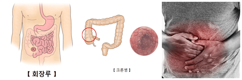 회장루, 크론병, 복통 사진
