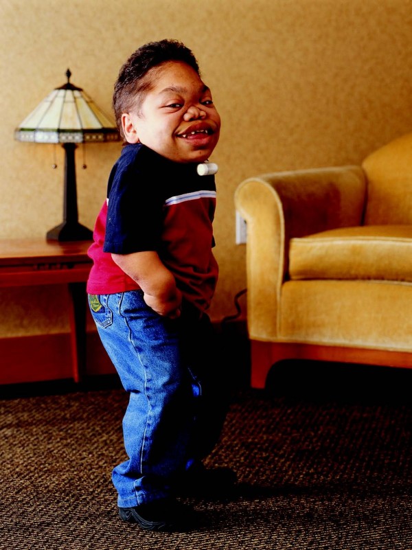 마로토-라미 증후군