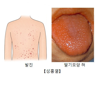 성홍열 증상, 원인, 치료