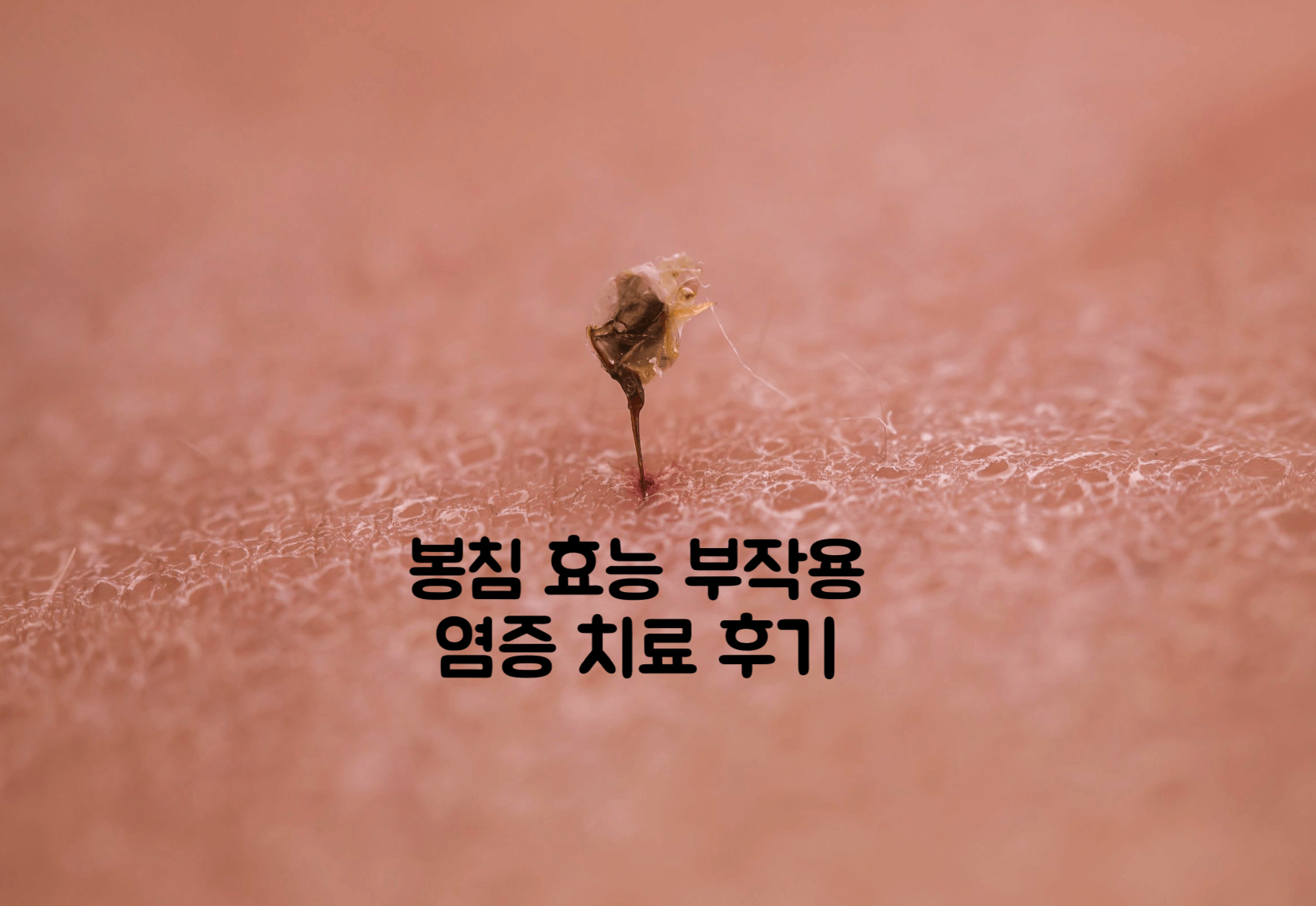 봉침 효능