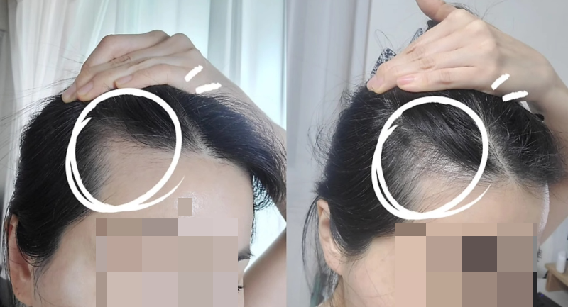여성 탈모, 건조함과 모발의 힘이 없어지는 것이 특징, 두피&amp;헤어팩으로 모근 영양을 집중 공급