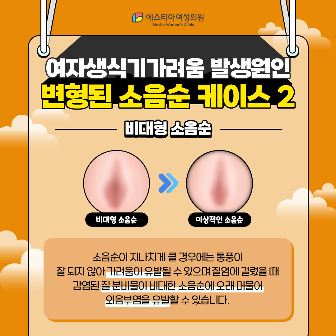 비대형 소음순