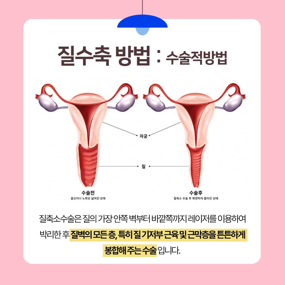 신논현산부인과 불감증 질수축 방법 질축소수술