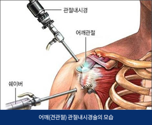 관절경수술