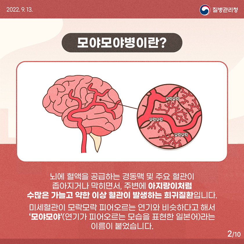 모야모야병 유전 증상 원인 치료 수술