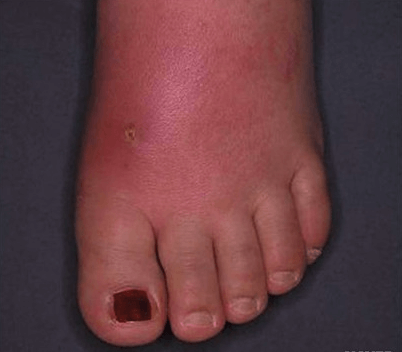 발에-온-봉와직염