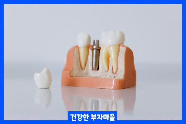 티타늄 임플란트 독성이 없고 내구성 좋다