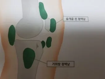 거위발 건염 원인과 증상 무릎 안쪽 통증 치료법 정리_12