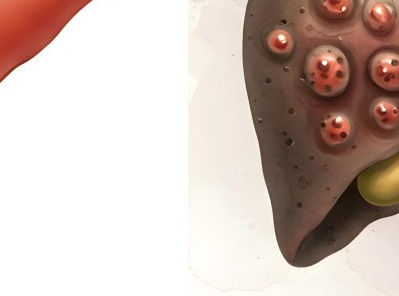 간경화 초기증상