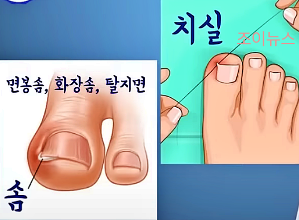 내성발톱 완충재로 자가치료__출처:김범수교수의발편한세상