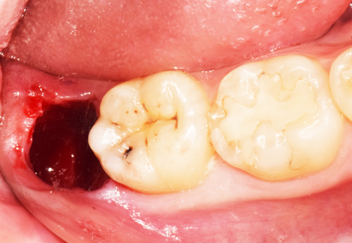 사랑니 발치 후 식사 가이드