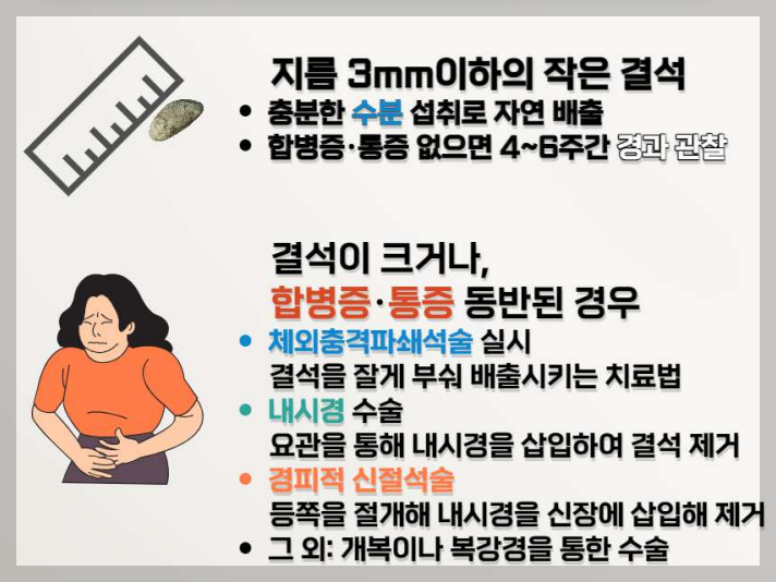 요로결석 치료