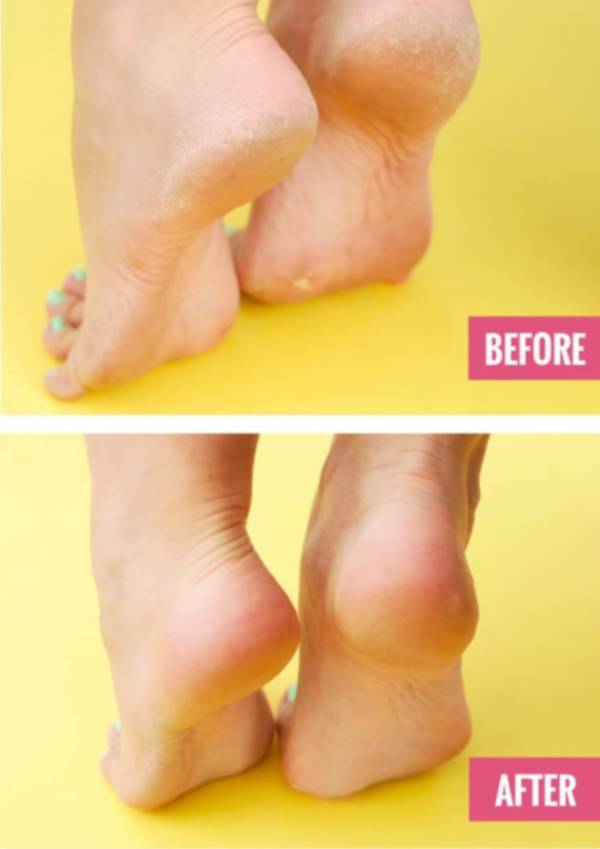 발각질제거 추천 방법