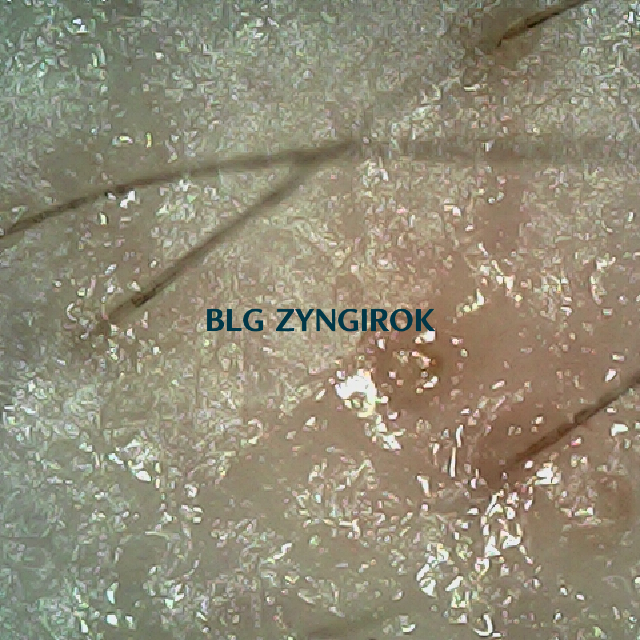 탈모 극복 프로젝트 - 오른쪽 M자 부위 두피 모습이다.