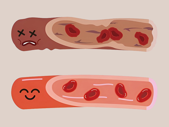 혈관의-건강상태-비교