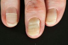 손톱 세로줄 무늬