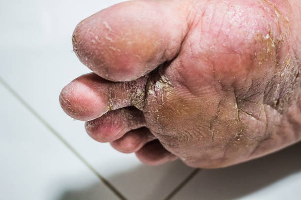 무좀 발 질환 치료 예방 피부과 여름 질환 증상 연고 전염 병원 원인 수포 스프레이 초기 무좀약 치료법 발톱무좀 약 민간요법 발톱 발바닥 발가락 발관리 발톱깎기 양말 링 각화증 뽑기 제거 바르는 약