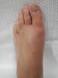 통풍