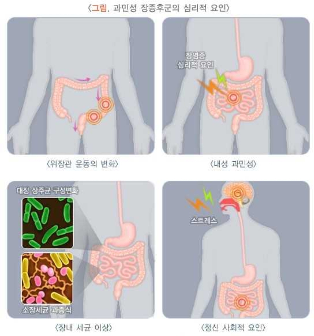 과민성대장 증후군 증상
