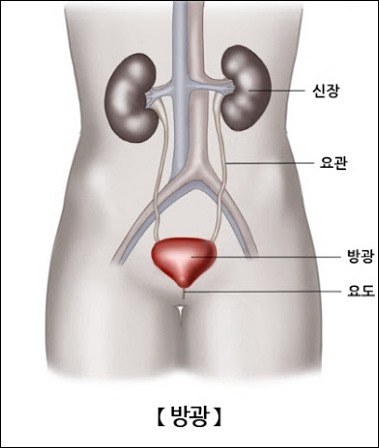 방광암 초기증상 -2
