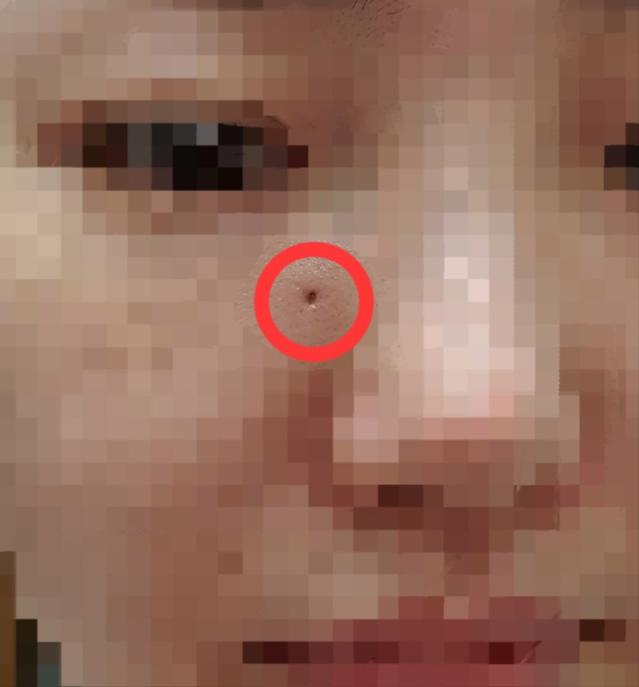 뾰루지를 짰는데 얼굴에 구멍이 생겼어요(위너확장구멍 없애기)