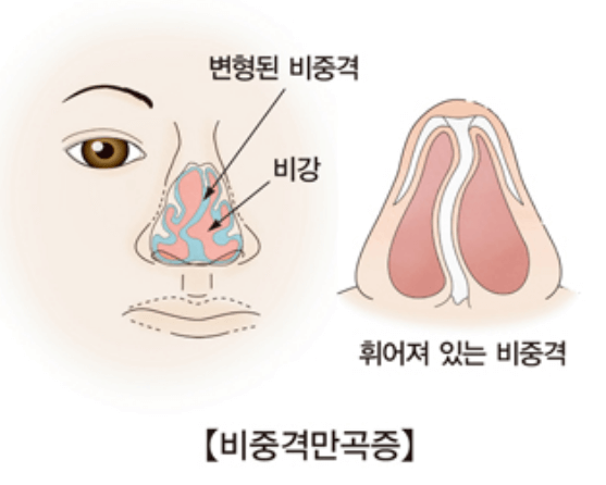 비중격만곡증-증상-치료-수술비용