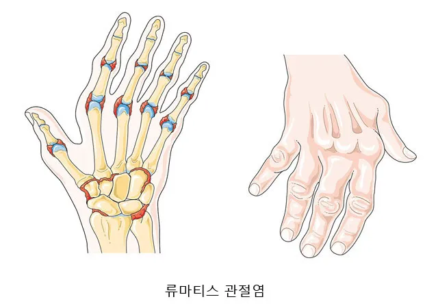 손가락 관절염 증상