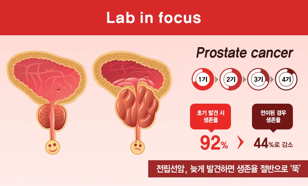 전립선암 초기증상