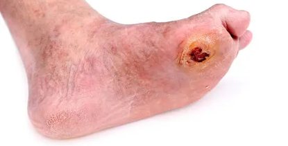 당뇨병성 족부궤양 완벽 관리