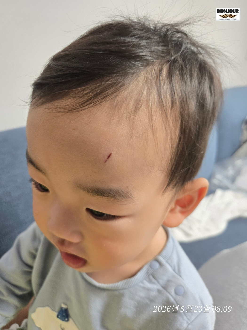 사고 12시간 후 딱지가 생긴 이마 모습