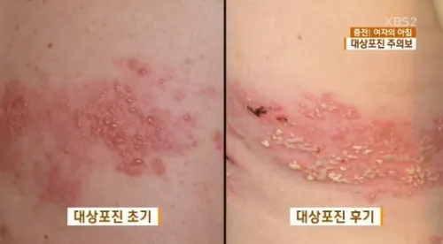 대상포진 병원어떤과로가나요