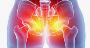 좌골신경통의 원인