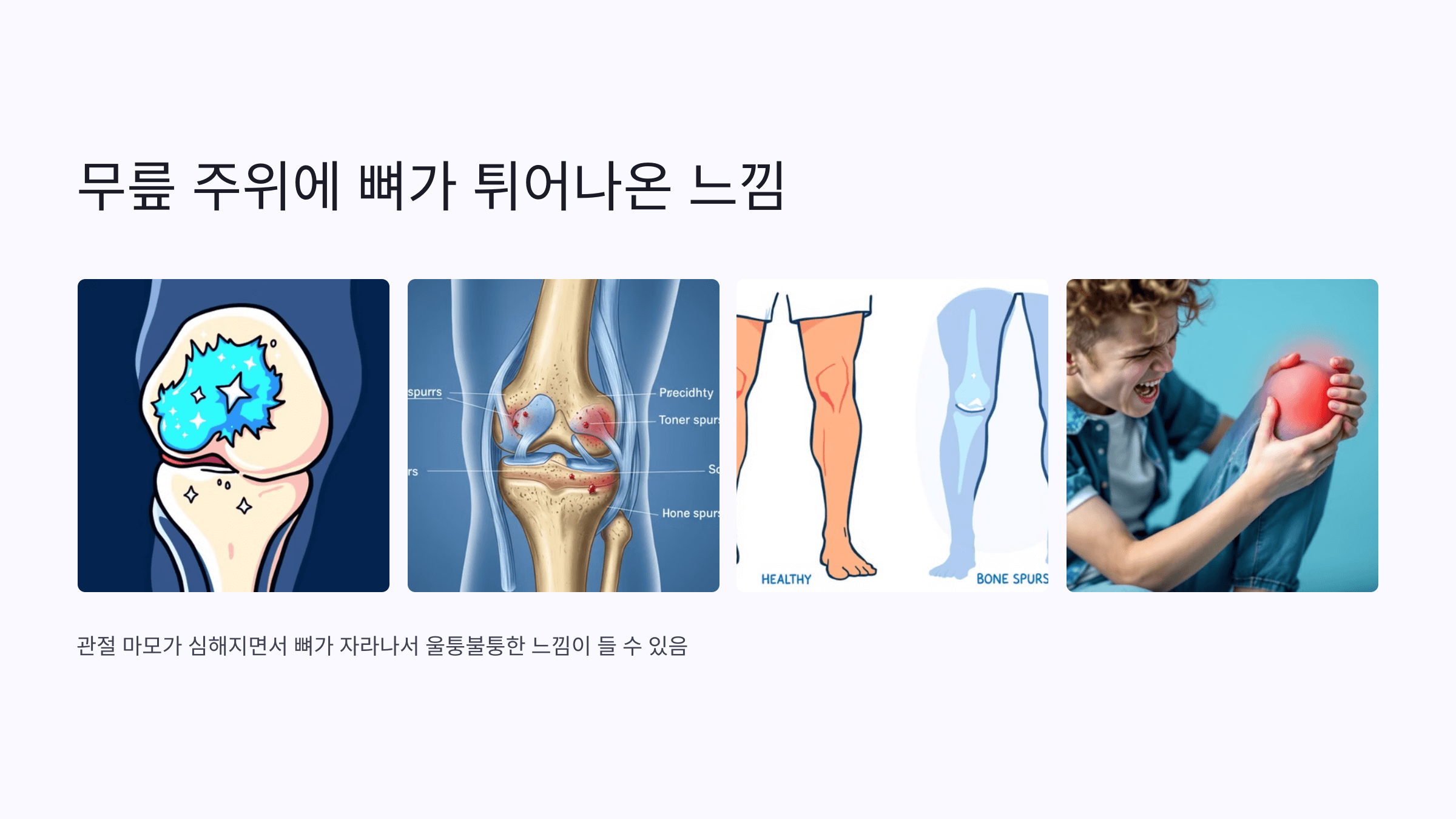 무릎 관절염 증상과 관련된 사진입니다.