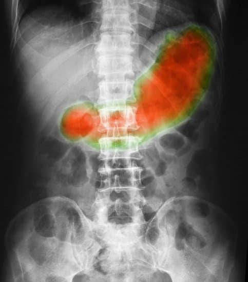 위하수증(Gastroptosis): 원인, 증상, 치료 및 관리 방법
