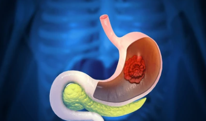위암 3기 생존율