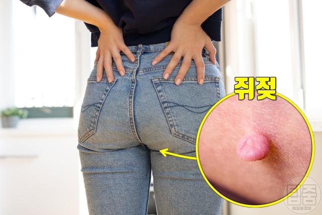 크론병 증상 항문 쥐젖 치루