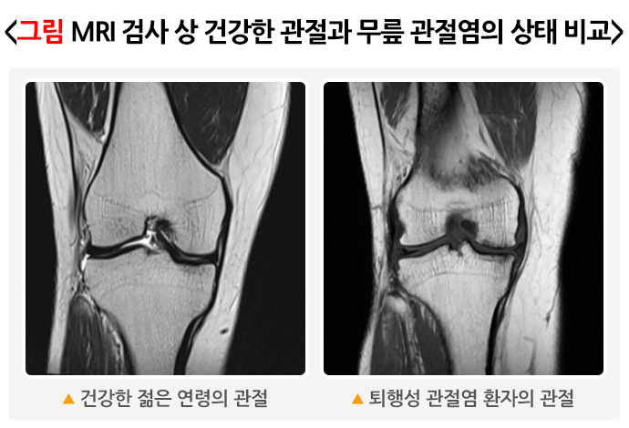 퇴행성관절염 원인, 증상, 예방, 치료방법