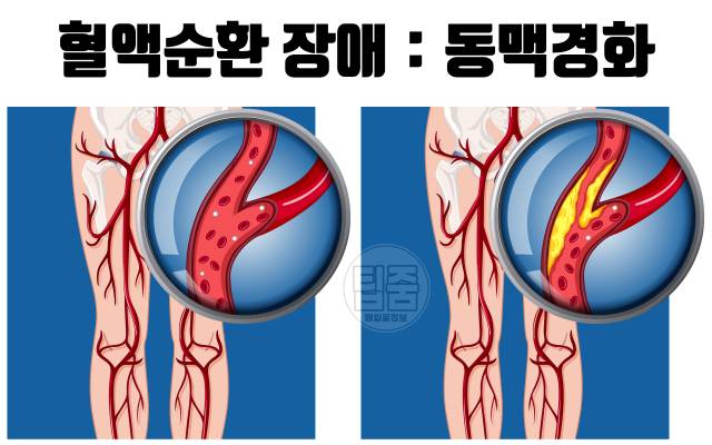 몸 혈액순환 안되면 나타나는 증상