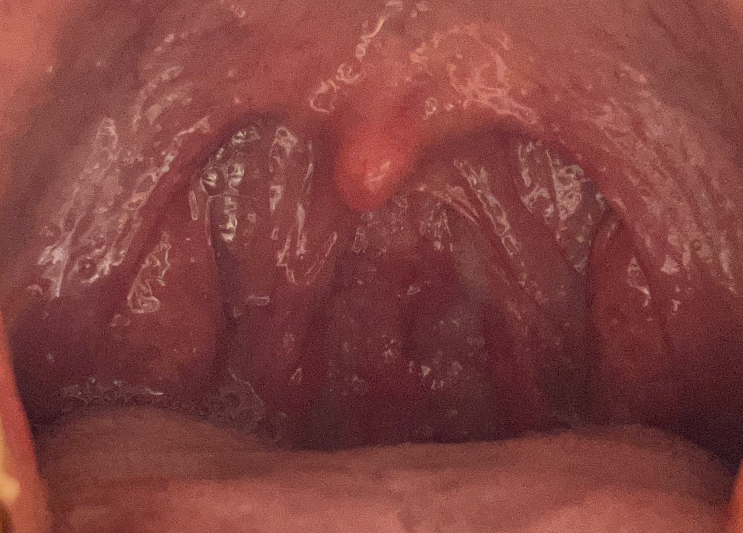 편도선 절제 수술 전 사진