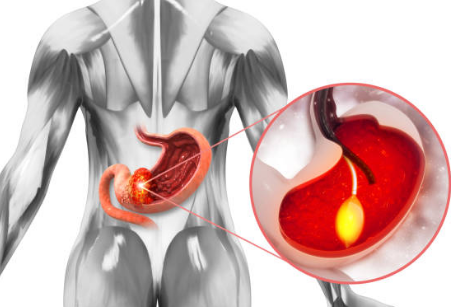 위암 초기증상, 수술비용, 수술후 회복기간 총정리 (2024ver)