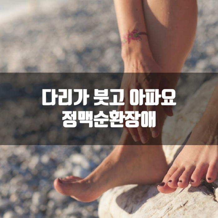 정맥순환장애와 하지부종 그리고 하지정맥류에 대해 알아본다.