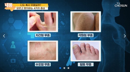 무좀증상과 원인