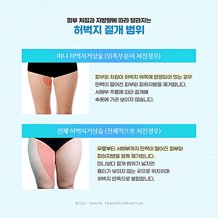 피부 처짐과 지방량에 따라 달라지는 허벅지 거상 절개 범위
1. 미니 허벅지 거상술 (위쪽부분이 처진경우)
2. 전체 허벅지 거상술 (전체적으로 처진경우)