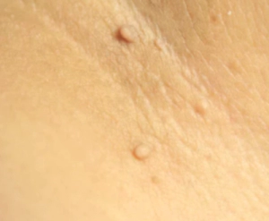 쥐젖이 생기는 이유&amp;#44; 쥐젖 제거방법