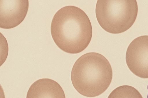 백혈병·림프종·골수종의 종류와 원인, 초기증상 총정리