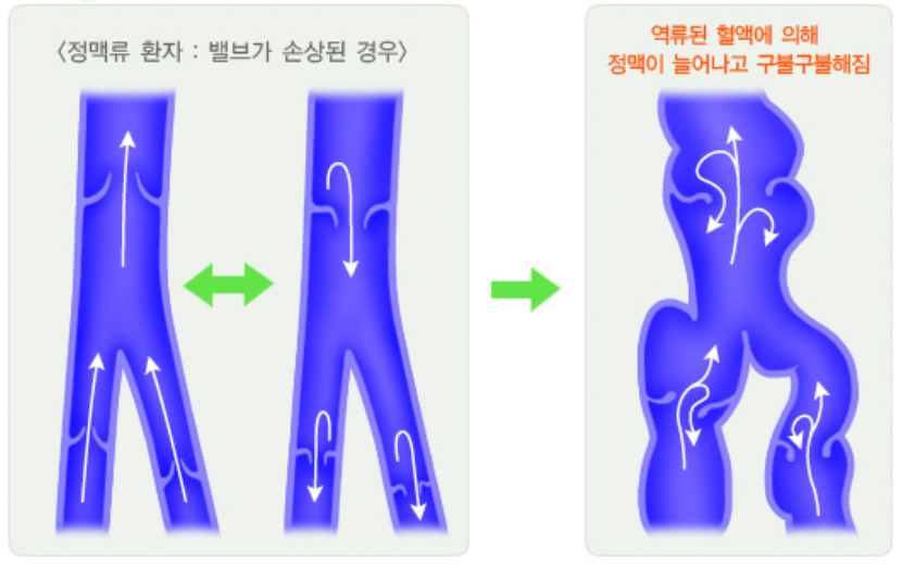정맥류가 발생하는 기전