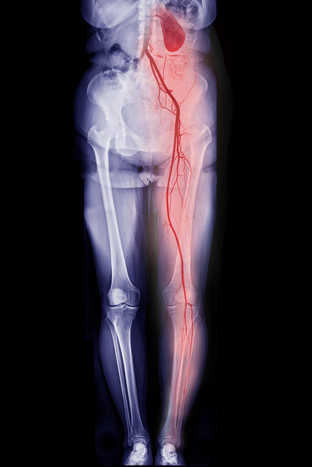 말초동맥질환(PAD, Peripheral Artery Disease) &ndash; 하지 혈관 협착 &amp; 혈류 장애