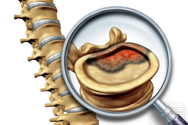 허리가 찌릿 아플때 척추관협착증 증상 원인 종양
