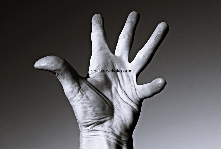 류마티스 관절염 초기증상