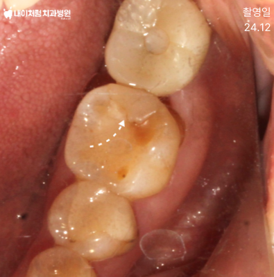 본드필 사용 후